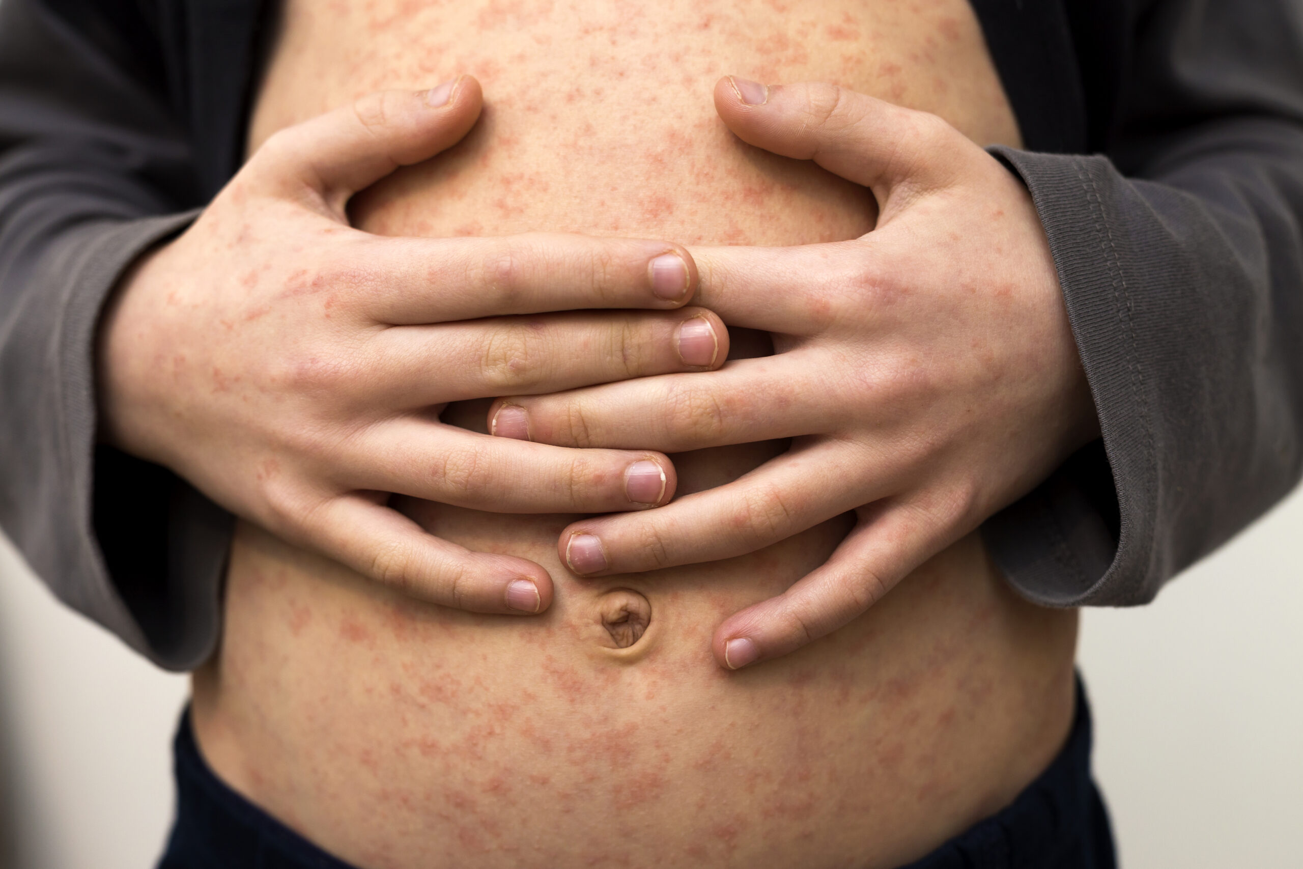 Des cas de rougeole ont été détectés à Saint-Hyacinthe et la Direction de la santé publique a publié les lieux fréquentés par les personnes infectées afin de mettre en garde la population non vaccinée. Photo ezfotos